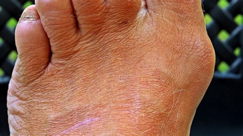 complicații ale varicelor picioarelor